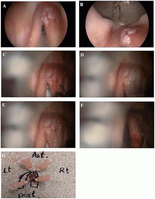 Single Stage Transoral Laser Microsurgery for Early Glottic Cancer